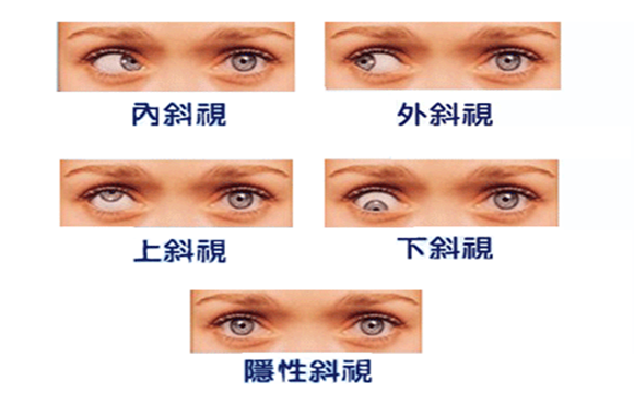 怎样治疗斜视(俗称斗鸡眼,斜眼)