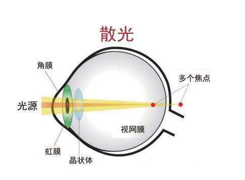 为什么散光时有时无,散光时有时无怎么回事