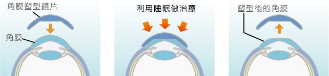 角膜塑形镜的原理
